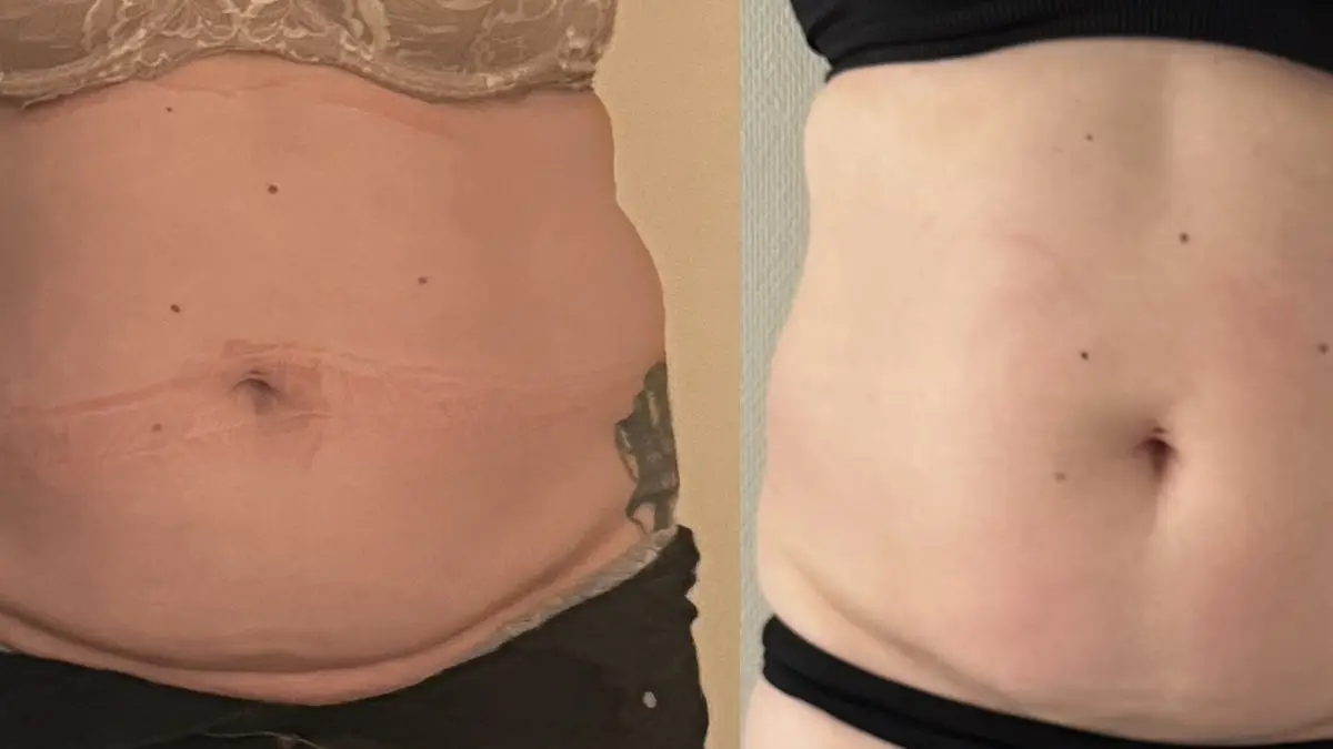 Tecar-EMS Elektrostimulering