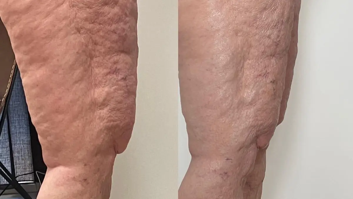 Tecar-EMS Elektrostimulering