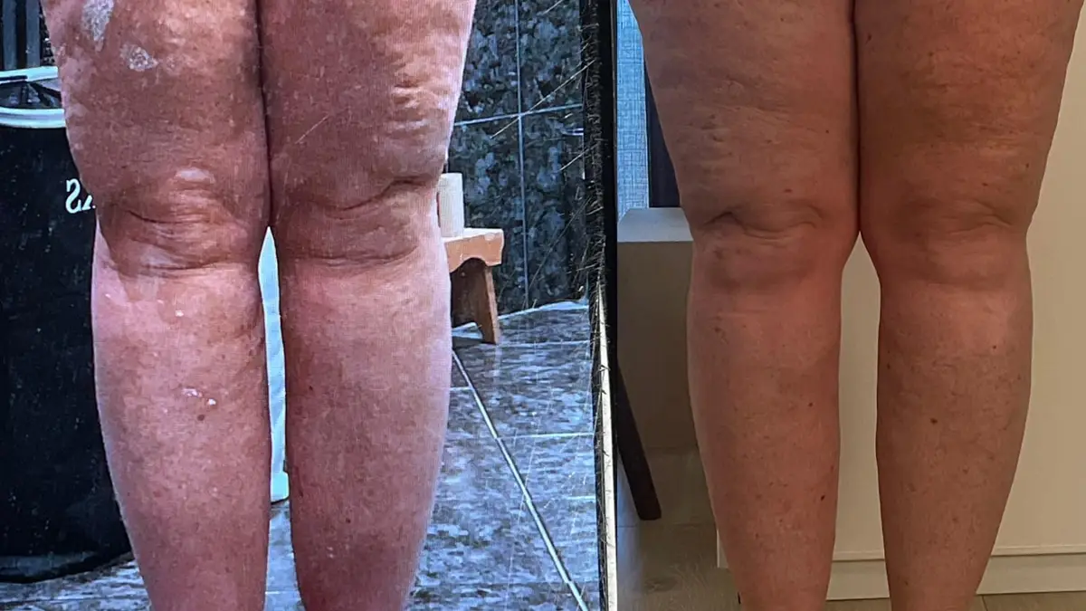 Tecar-EMS Elektrostimulering