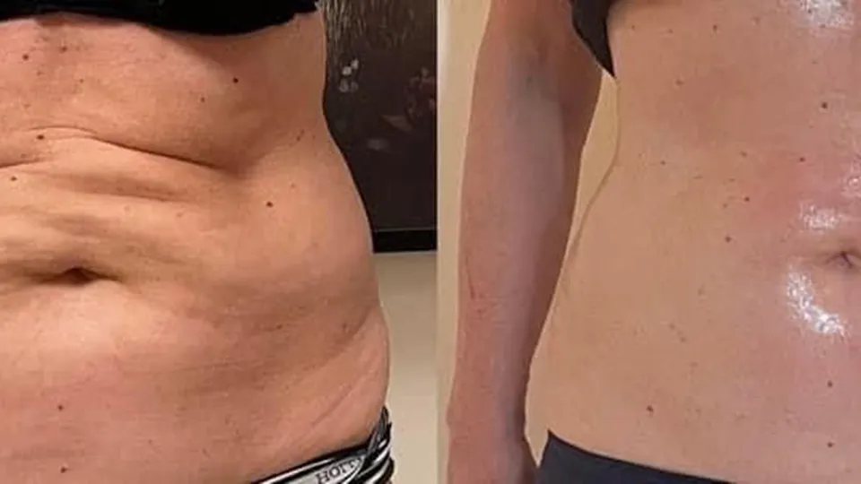 Tecar-EMS Elektrostimulering